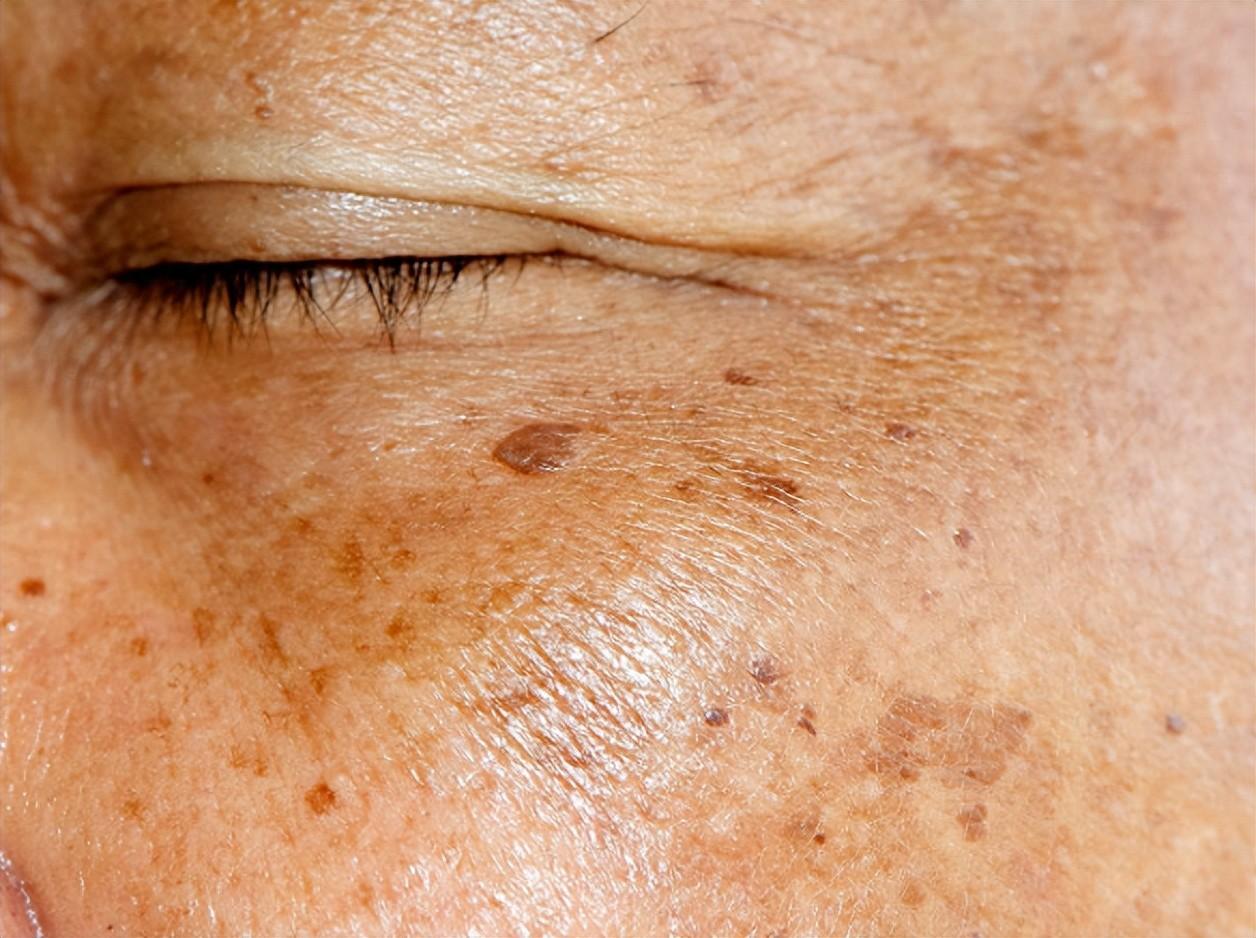  Age Spots: Causes, Prevention, and Treatment